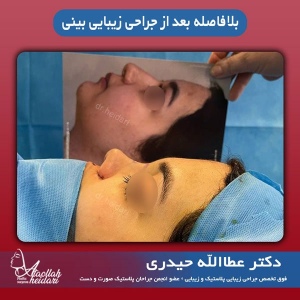 جراحی-بینی-گوشتی-1