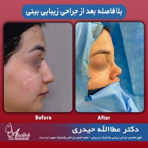 جراحی-بینی-1
