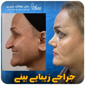جراحی-بینی-131
