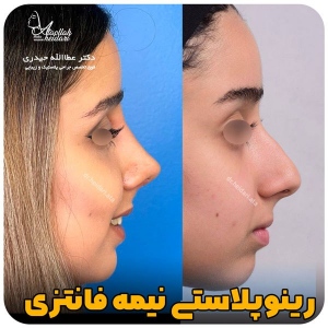 جراحی-بینی-134