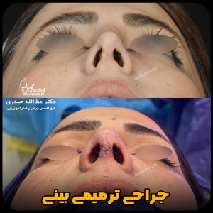 جراحی-بینی-137