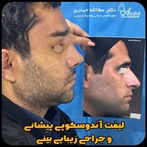 جراحی-بینی-138
