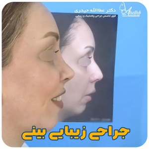 جراحی-بینی-140