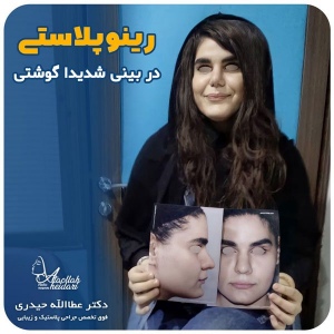 جراحی-بینی-142