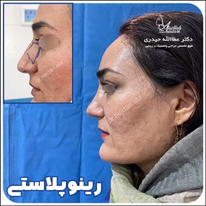 جراحی-بینی-144