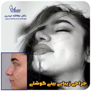 جراحی-بینی-145