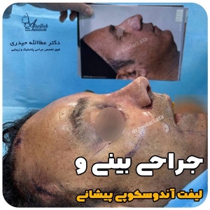 جراحی-بینی-146