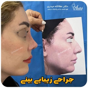 جراحی-بینی-147