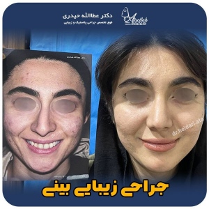 جراحی-بینی-148