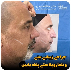 جراحی-بینی-152