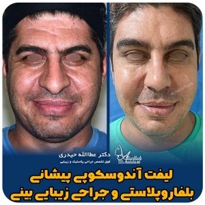 جراحی-بینی-155