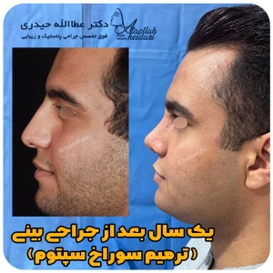 جراحی-بینی-157