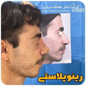 جراحی-بینی-158