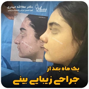 جراحی-بینی-160