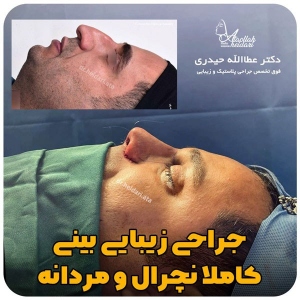 جراحی-بینی-161