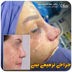 جراحی-بینی-167