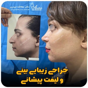 جراحی-بینی-169