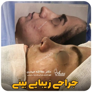 جراحی-بینی-170