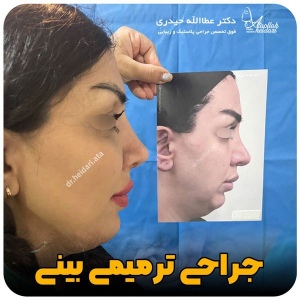 جراحی-بینی-172