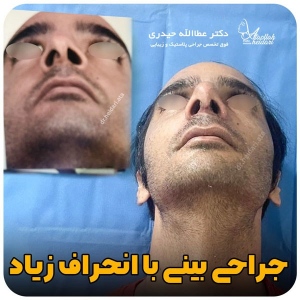 جراحی-بینی-174