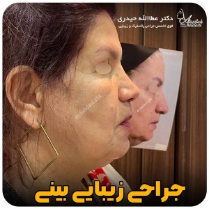 جراحی-بینی-175