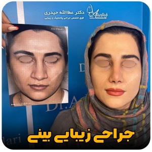 جراحی-بینی-177