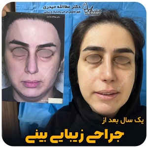جراحی-بینی-178
