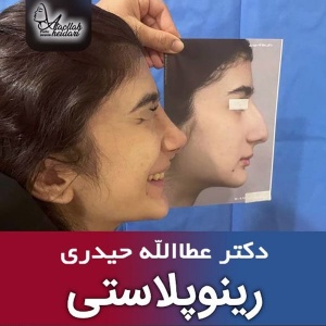 جراحی-بینی-179
