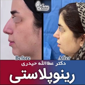 جراحی-بینی-180