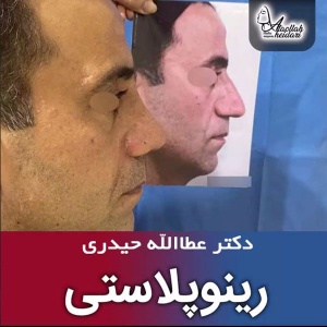 جراحی-بینی-181
