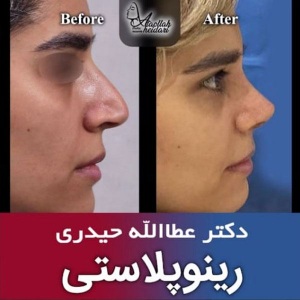 جراحی-بینی-182