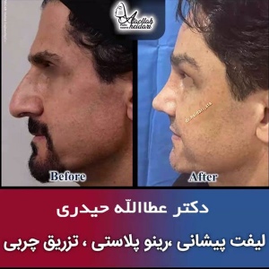 جراحی-بینی-183