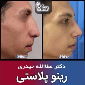 جراحی-بینی-184