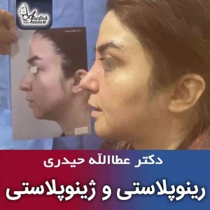 جراحی-بینی-185