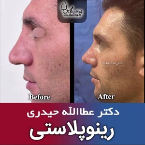 جراحی-بینی-186