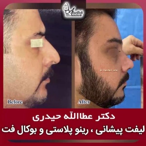 جراحی-بینی-188