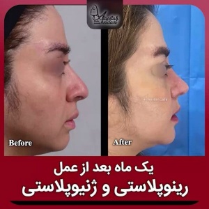 جراحی-بینی-189
