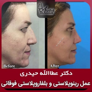 جراحی-بینی-191