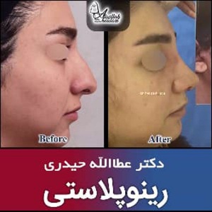 جراحی-بینی-193