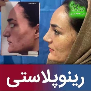 جراحی-بینی-214