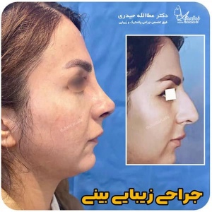 جراحی-بینی-215