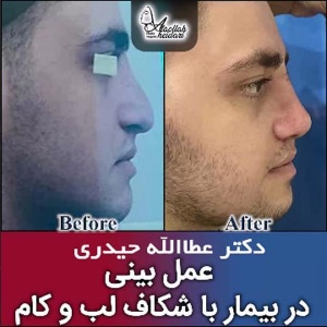 جراحی-بینی-231