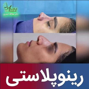 جراحی-بینی-233