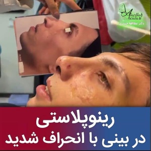 جراحی-بینی-234