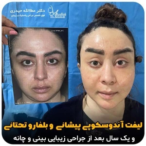 جراحی-بینی-259