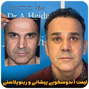 جراحی-بینی-260