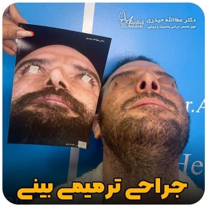 جراحی-بینی-262