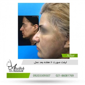 facelift4