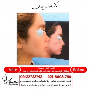 fat-injection1