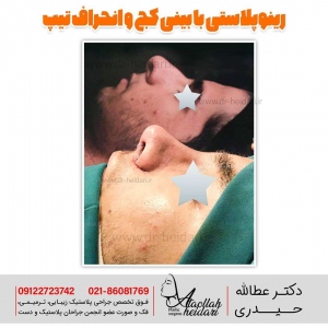rhinoplasty1